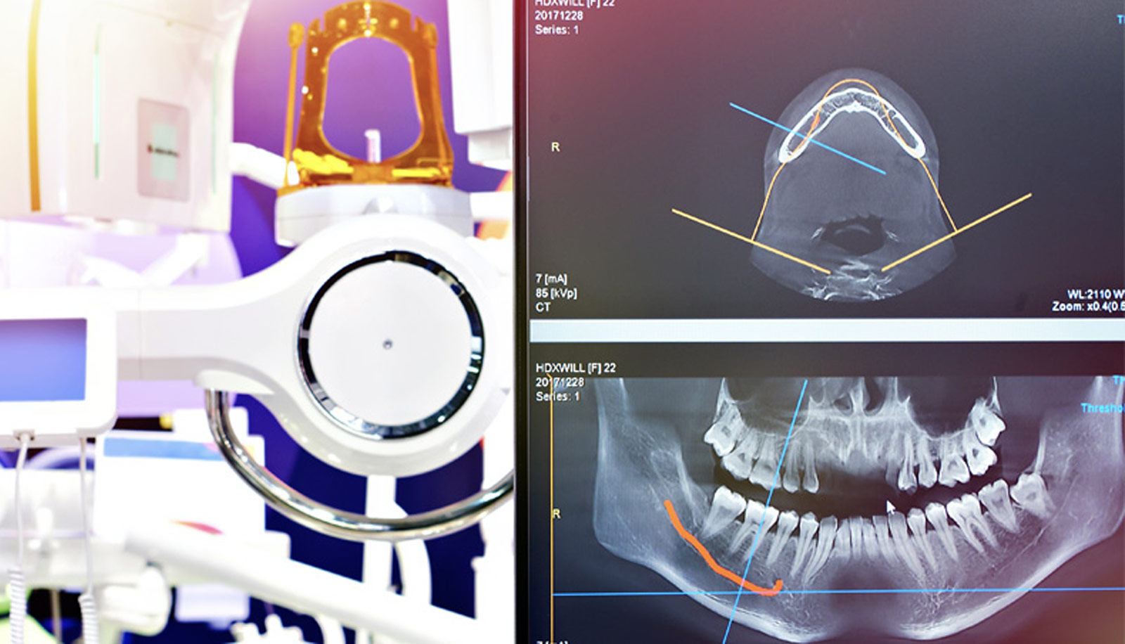 Dental Treatments in Lawrence Township